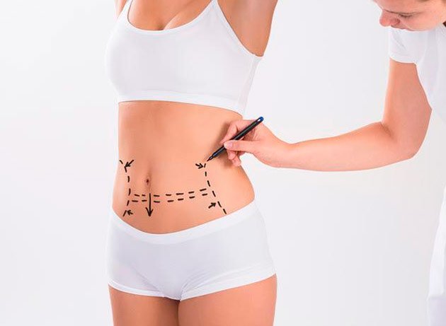 tipos de abdominoplastia