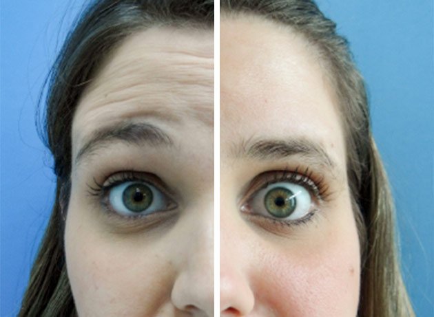 Paciente antes y después del tratamiento con toxina botulinica