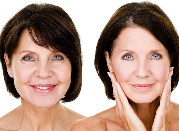 Paciente mostrando rostro antes y después del lifting facial