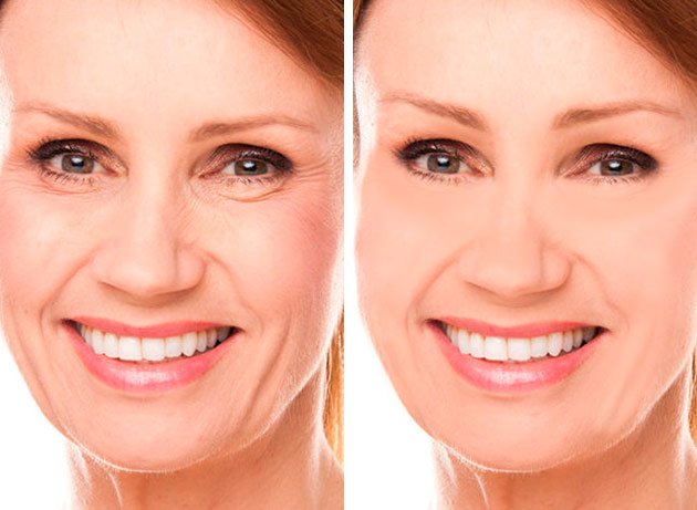 Paciente mostrando su rostro antes y después de un lifting o estiramiento facial